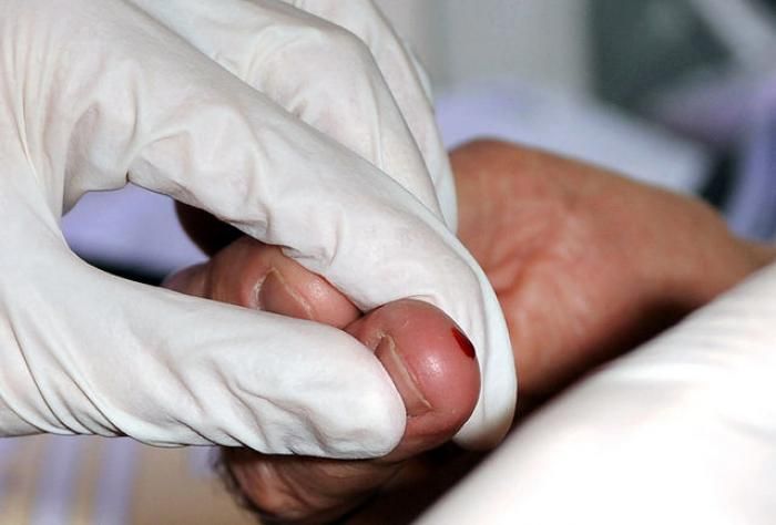 Día Mundial contra la Hepatitis: Lanzan campaña de tests gratuitos