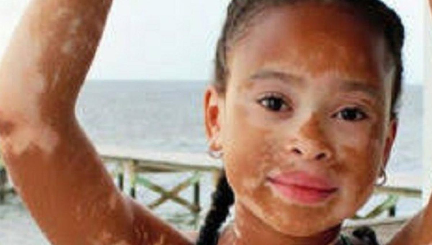 25 de junio: Día Mundial del Vitiligo