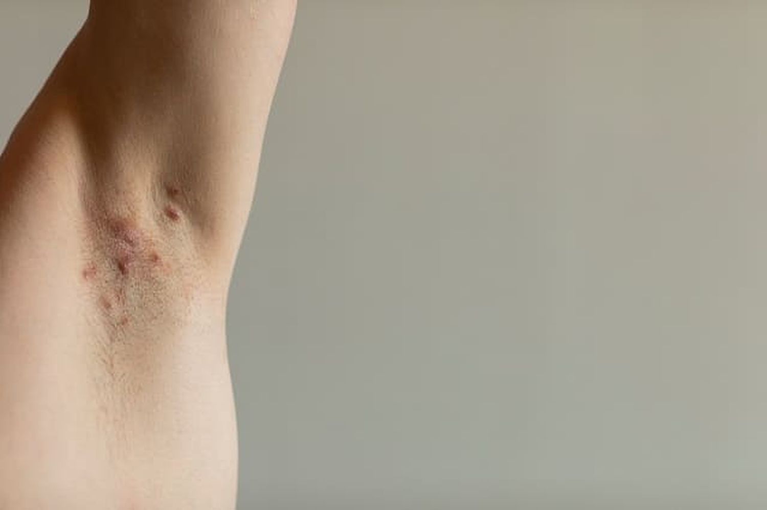 Hidradenitis supurativa, la patología recurrente de piel