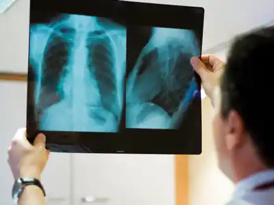 Cáncer de pulmón: una enfermedad que sigue desafiando a la ciencia y exige un compromiso colectivo