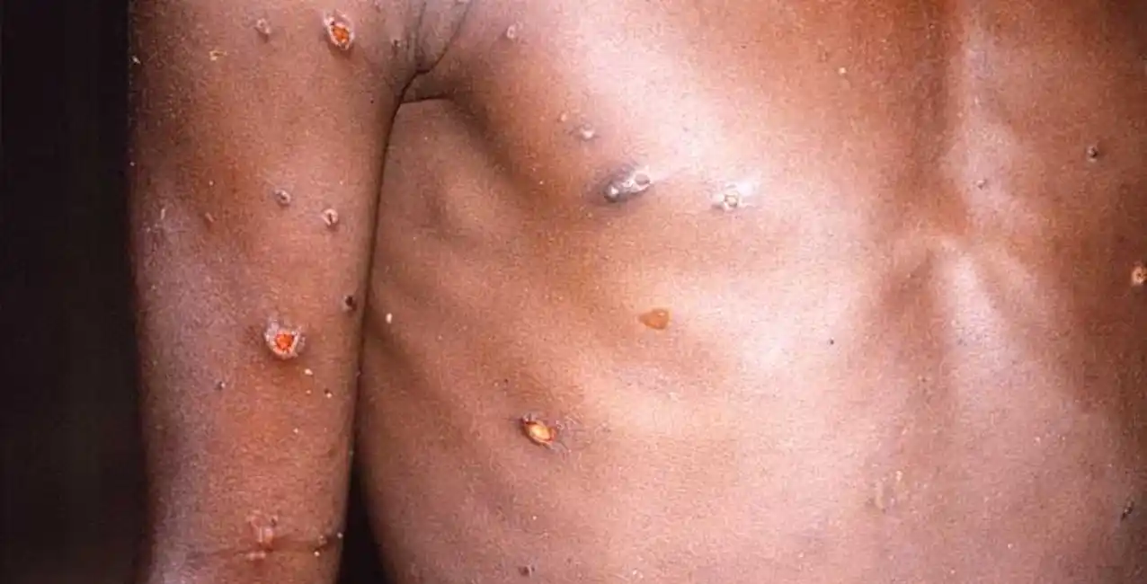 Brasil: se confirma la primera muerte por la viruela de mono