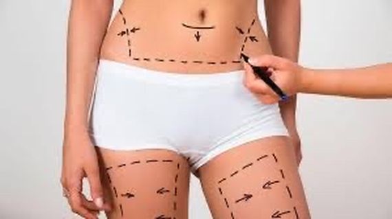 Aspectos a tener en cuenta a la hora de pensar en una lipoescultura