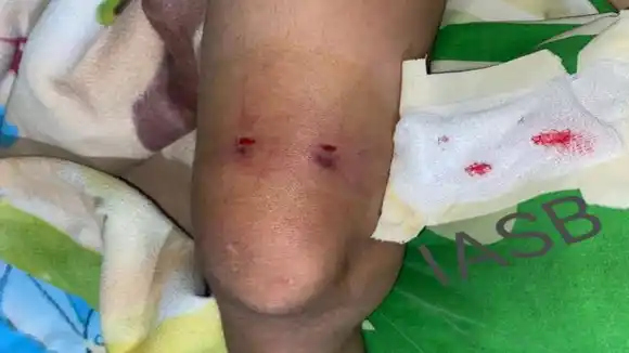 Escasez de suero antiofídico tiene a un niño mordido por mapanare debatiéndose entre la vida la muerte