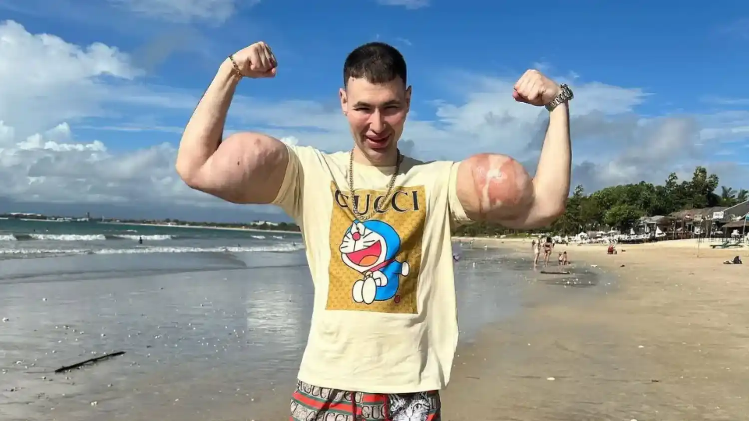 La obsesión del “Popeye ruso” por unos bíceps gigantes podría costarle los brazos si no mejora su salud