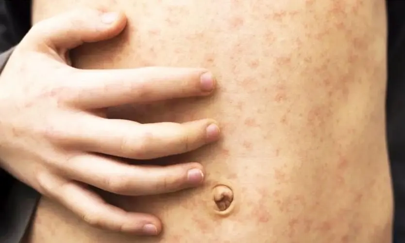 Sarampión: siguen creciendo los contagios en el AMBA