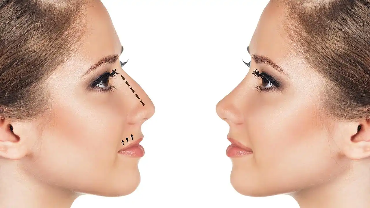 Rinoplastia y Rinomodelación, similitudes y diferencias