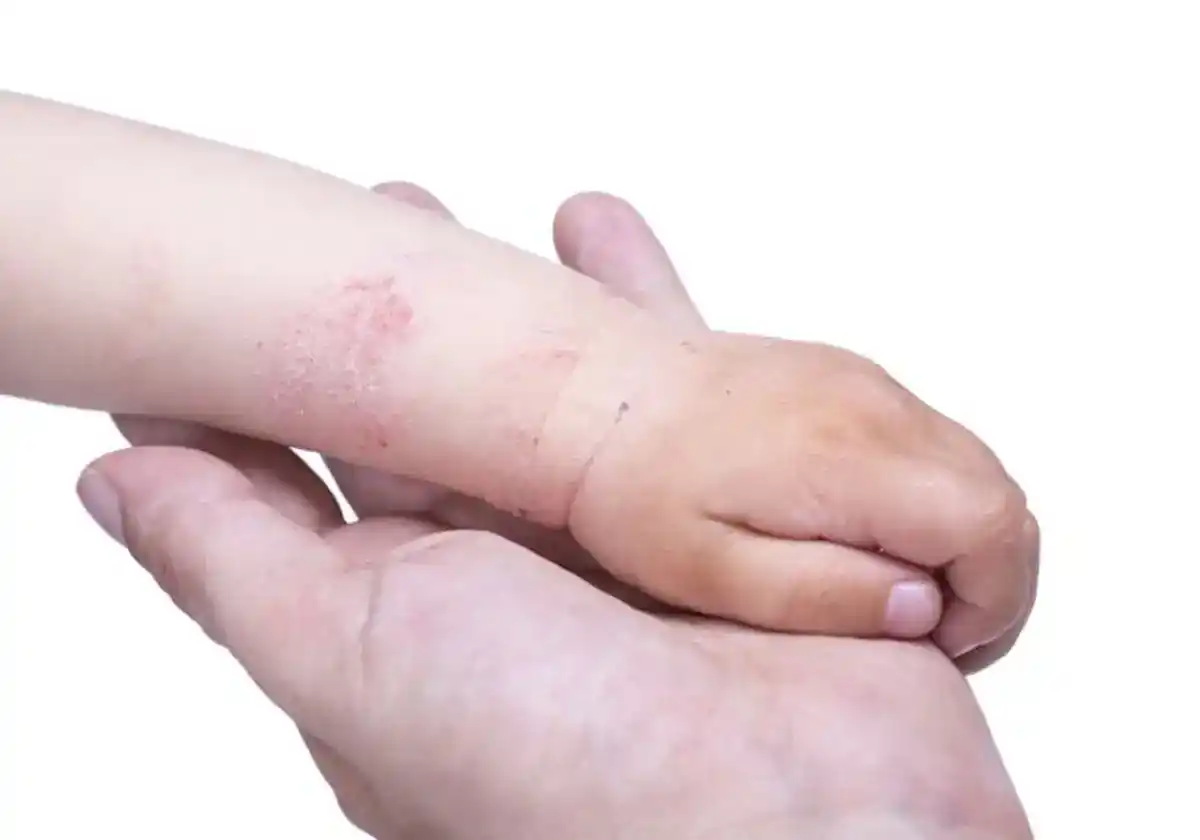 Las cremas de corticoides aumentan el riesgo de osteoporosis