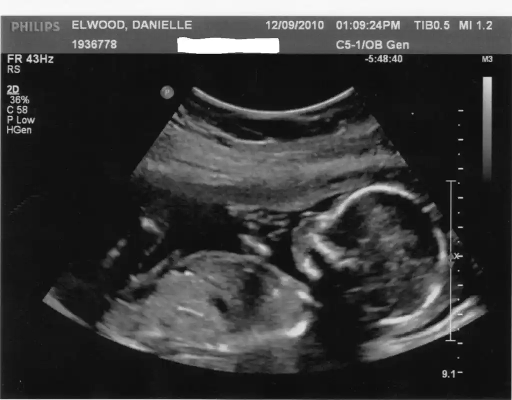 Rosario participó de un estudio mundial sobre diagnóstico prenatal