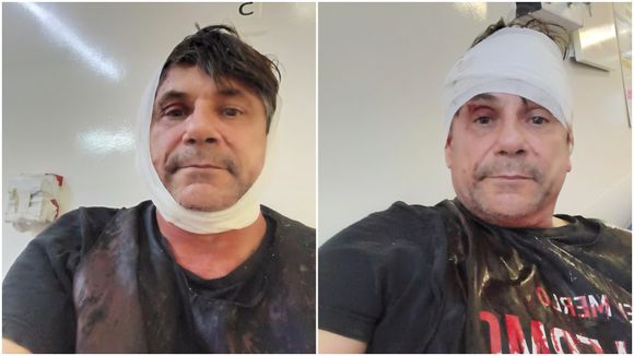 Denuncian que le dieron un culatazo en la cabeza a un candidato a concejal mientras pegaba afiches en Merlo