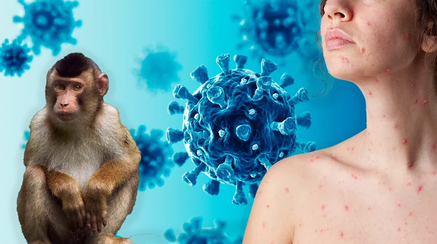 Viruela del mono: experto de la OMS estimó que no se tardará mucho en declarar la pandemia