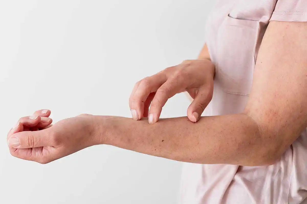 El 40% de los niños con dermatitis
atópica sufre acoso escolar