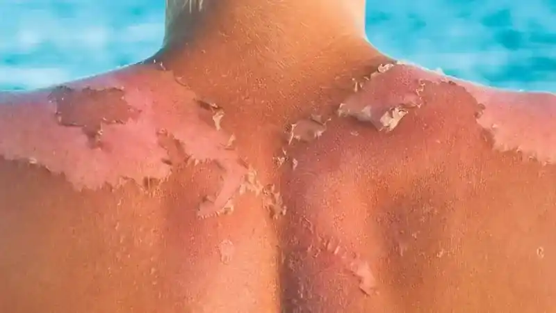 Ola de calor e insolación: remedios buenos y baratos para aliviar el exceso de sol