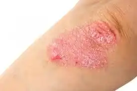 Psoriasis