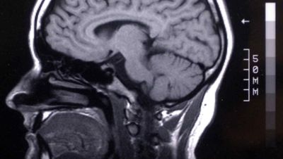 Día mundial del cerebro: las enfermedades neurológicas, primera causa de discapacidad en el mundo
