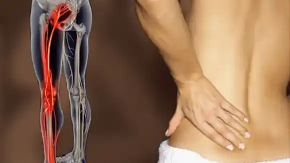 Dolor lumbar y calambres en la pierna:  ¡Cuidado puede ser la ciática!