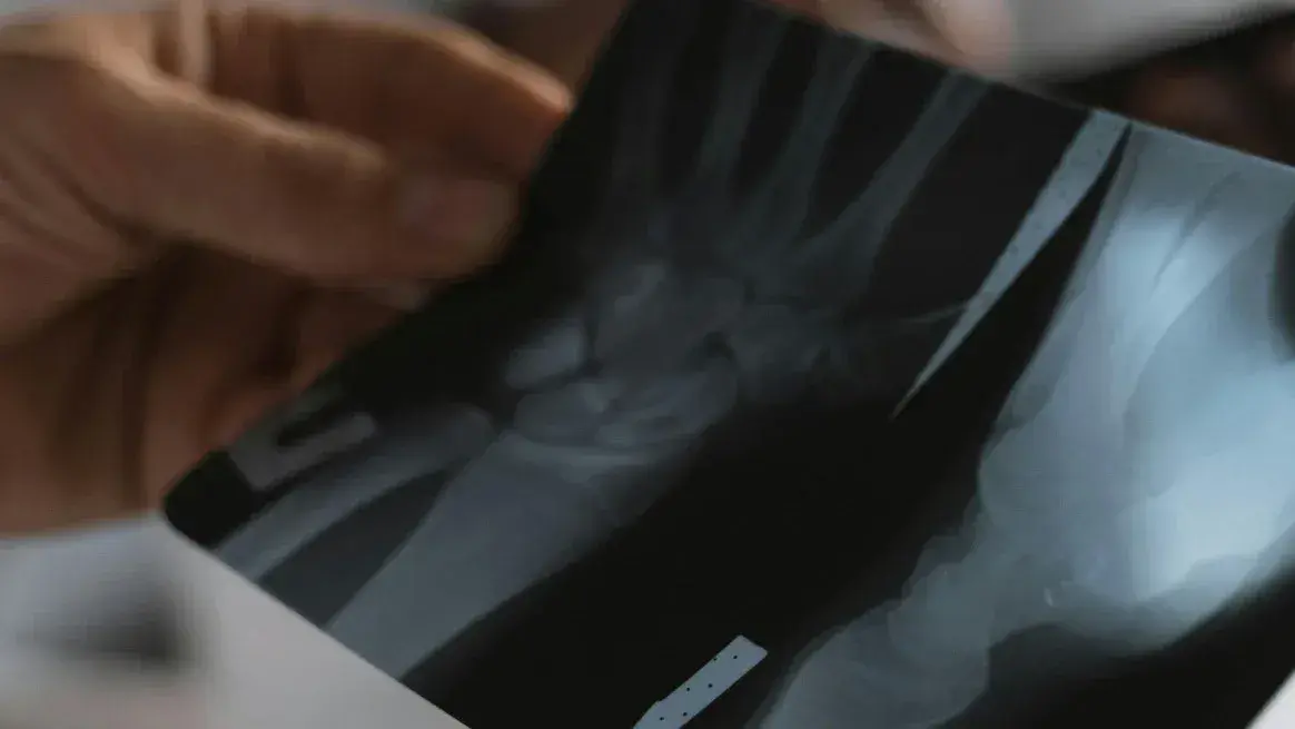 Podría aplicarse tanto en fracturas simples como en aquellas más complicadas.