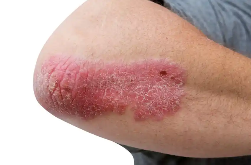 Psoriasis: afecta a alrededor del 3% de los marplatenses
