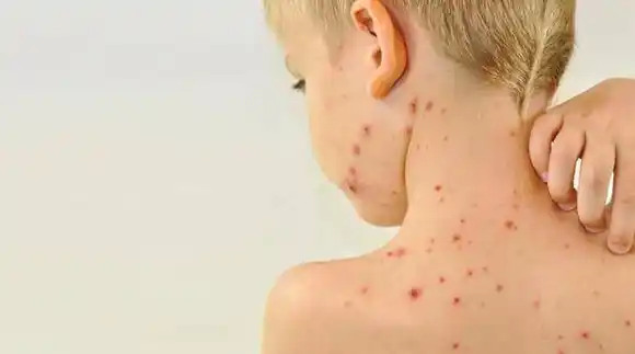 Nuevo caso de sarampión en Argentina