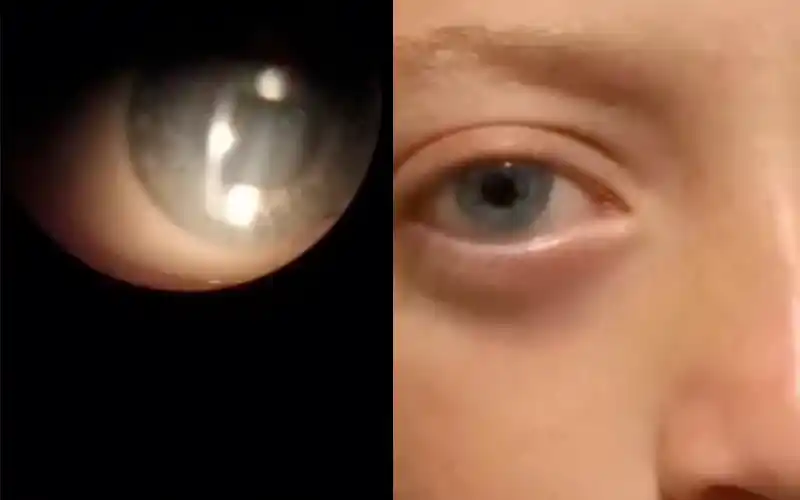 Reunieron el dinero para los anteojos del niño que perdió la visión de un ojo por un gomerazo