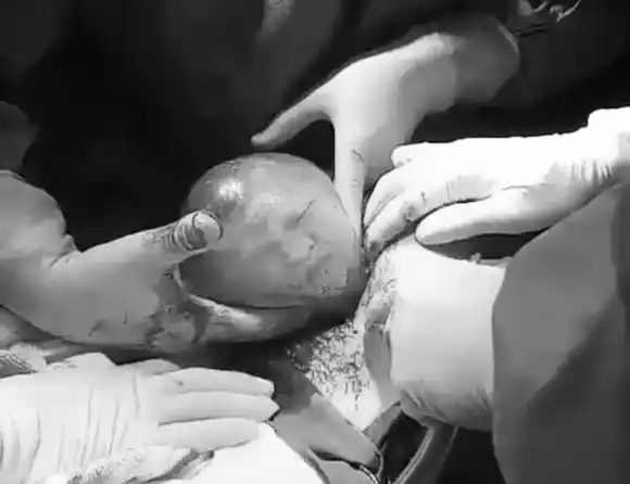 Día de la Obstetricia y un espectáculo poco frecuente: el parto enmantillado