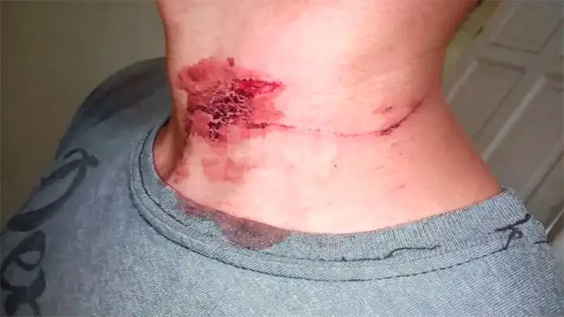 Pareja abordó a un joven que esperaba el colectivo y le cortaron el cuello para robarle