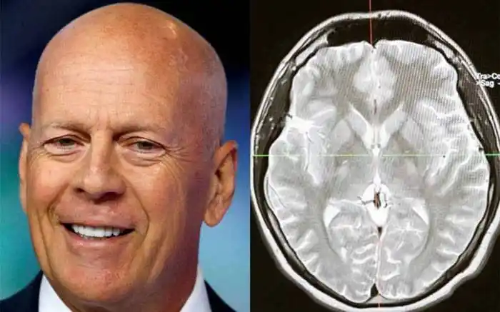 Qué es la demencia frontotemporal que padece Bruce Willis