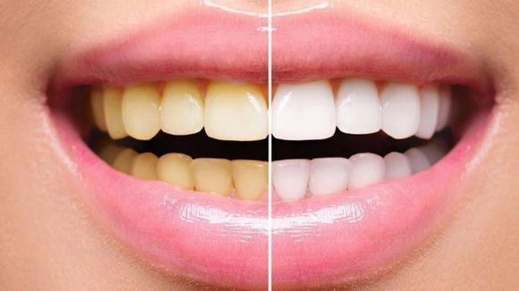 Cinco recomendaciones para unos dientes blancos y sanos