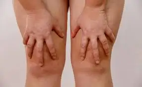 grasa en las piernas