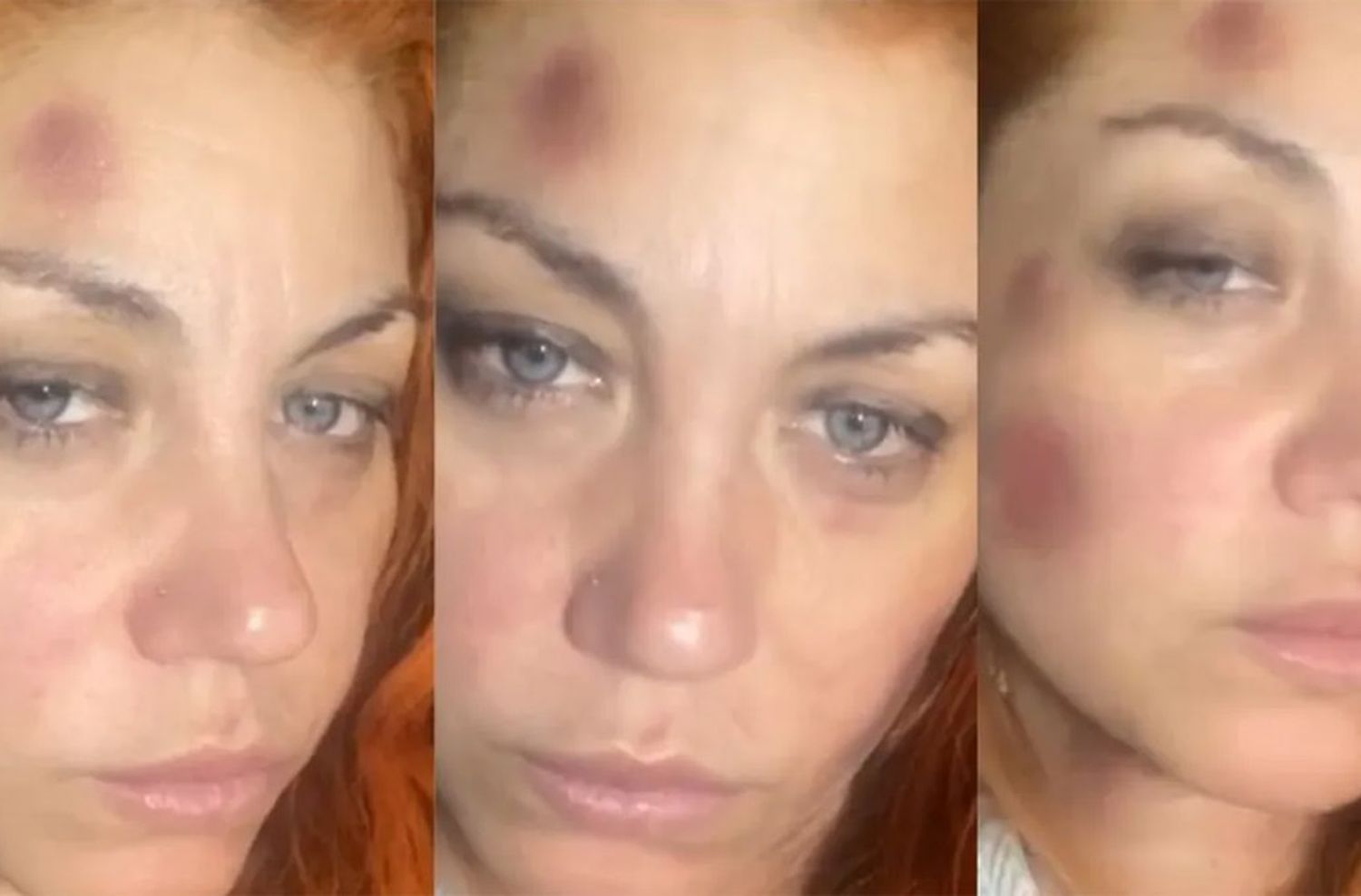 Grave denuncia de Lourdes de Bandana: acusó a su ex pareja de violencia física y mostró sus golpes en la cara