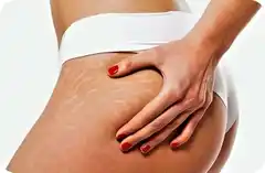 Estrías, un tema que preocupa a todas