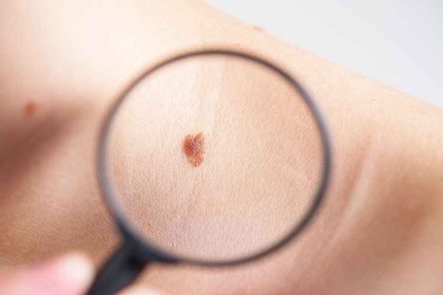 Día Mundial del Melanoma: la provincia recuerda la importancia de seguir conductas saludables