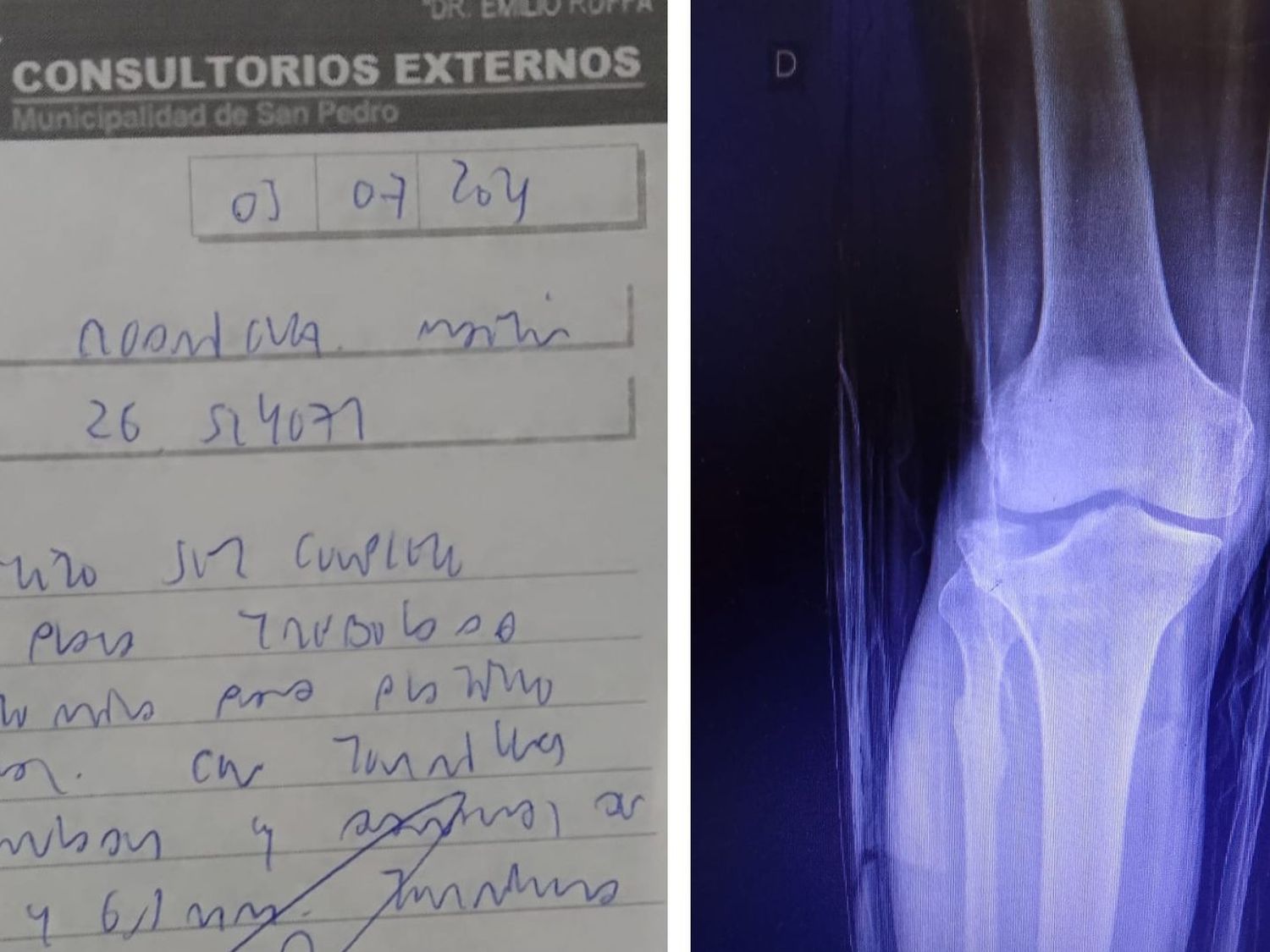 La orden del médico y la placa de la rodilla dañada que debe ser solucionada con una prótesis.