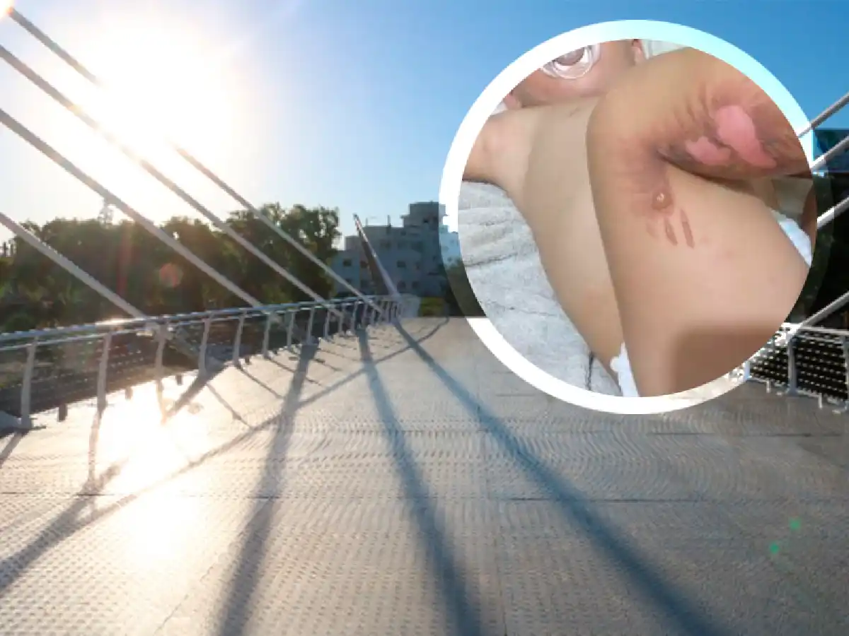 Un niño sufrió quemaduras en el nuevo puente de Carlos Paz