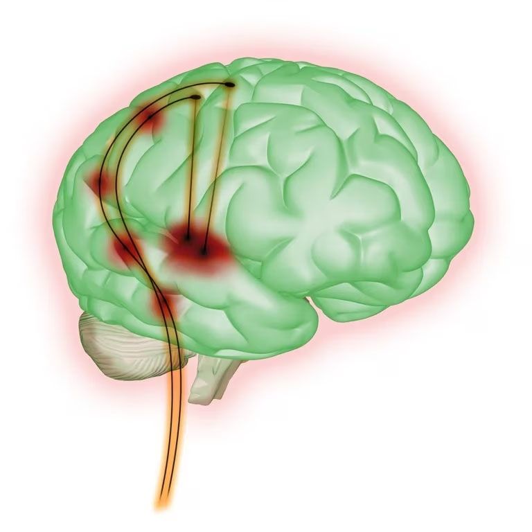 Una forma de epilepsia que se inicia en la infancia: por qué es clave el diagnóstico temprano