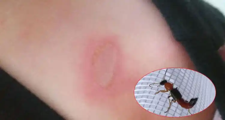 Epidemia: Aumentan los casos por dermatitis causado por el Paederus
