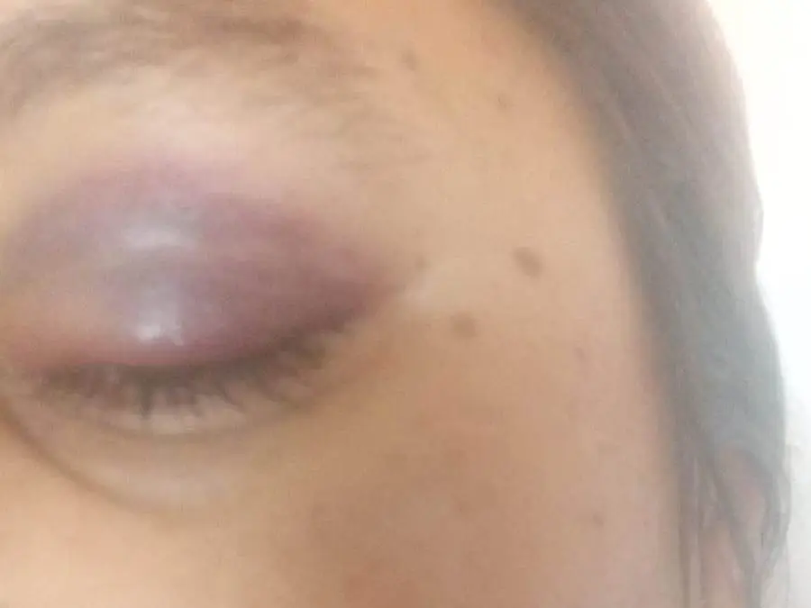 Una de las lesiones que le provocó su ex pareja