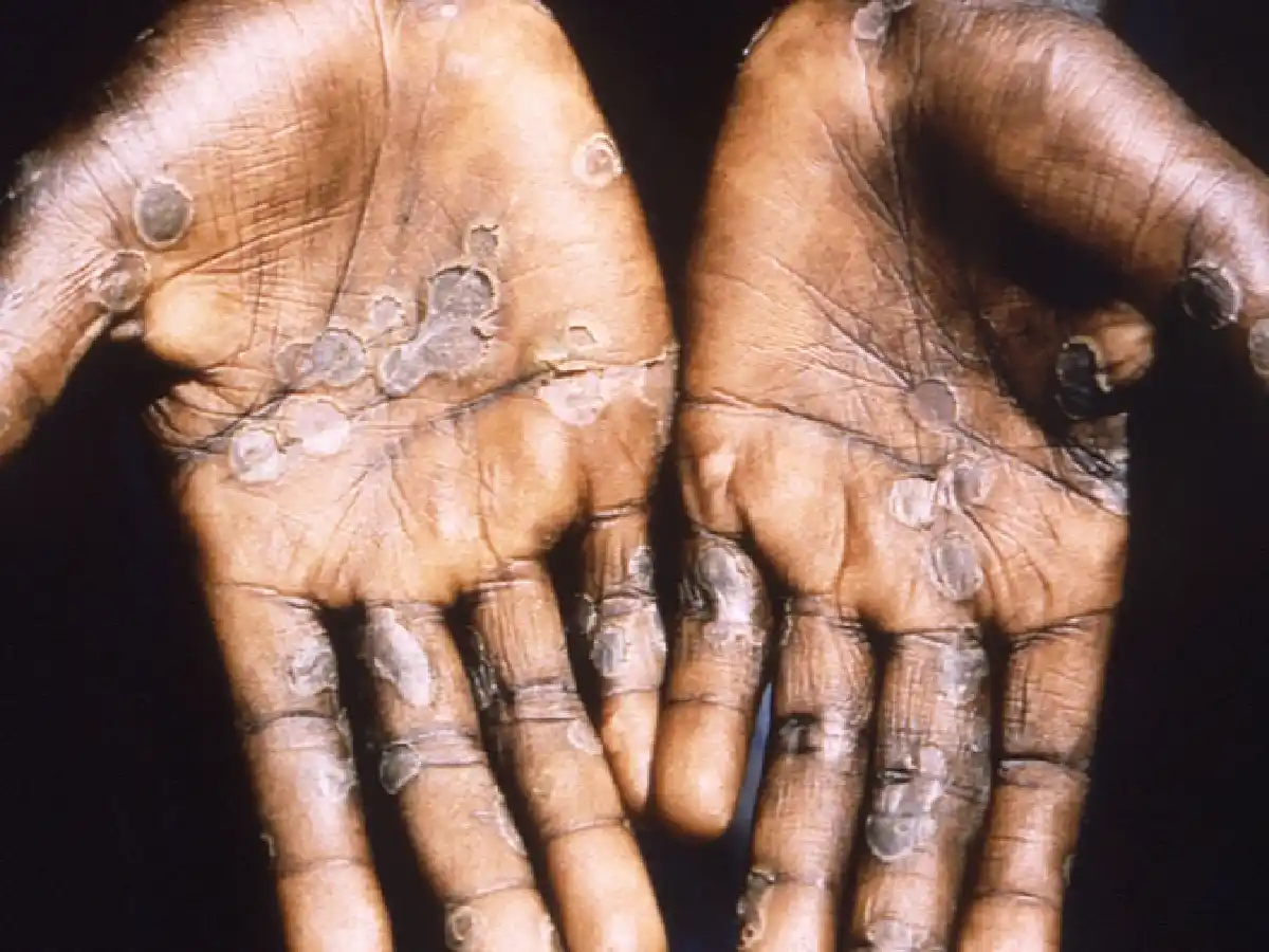 Salud evalúa un segundo caso sospechoso tras confirmar primer contagio en Argentina