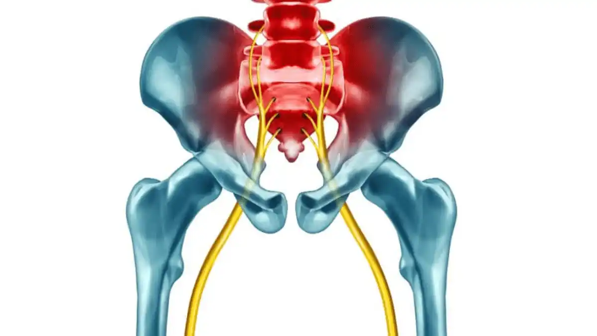 Así puedes aliviar los dolores de la ciática