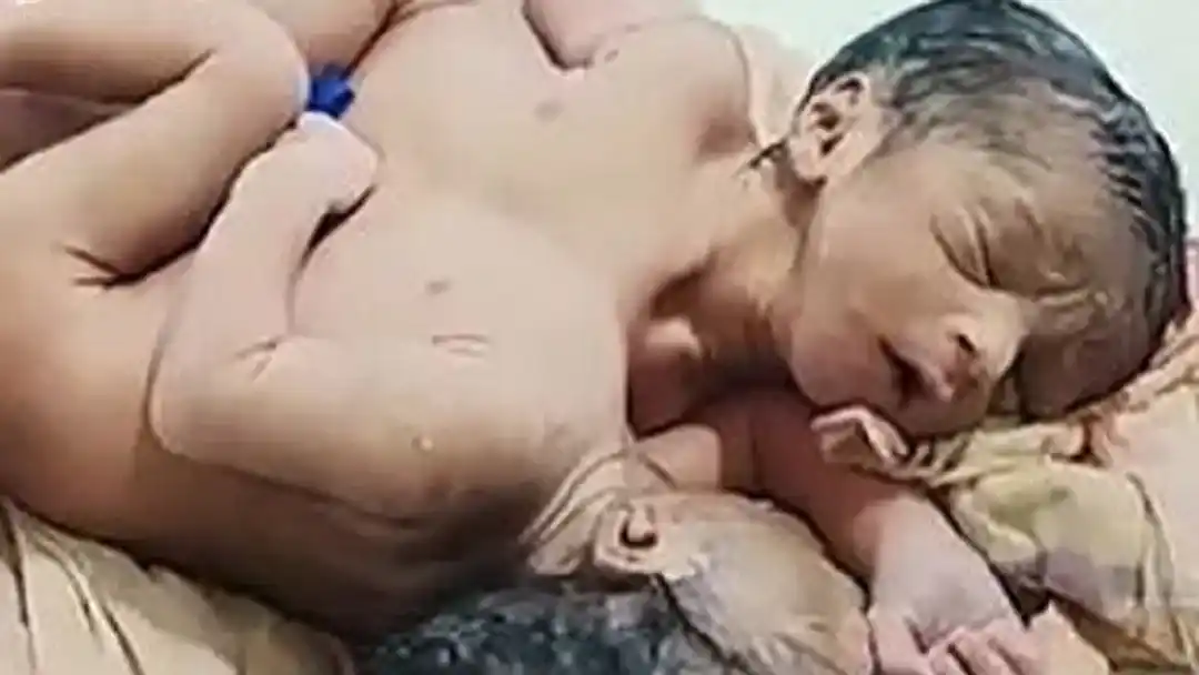 Conmoción en India: nacieron gemelos siameses unidos por el pecho