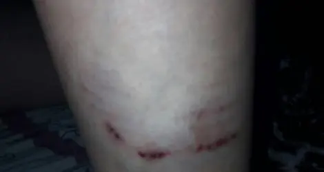 La mordió un perro en la vía pública