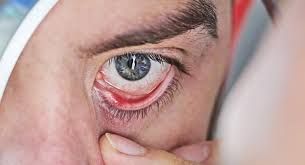 ATERRADOR HONGO NEGRO ataca a pacientes con coronavirus. ¿Qué es?
