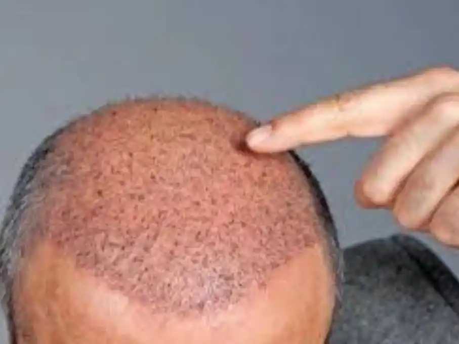 Un turista británico murió al someterse a un trasplante de pelo en Turquía. (Foto: Google Maps/AFP/Sajjad Hussain).