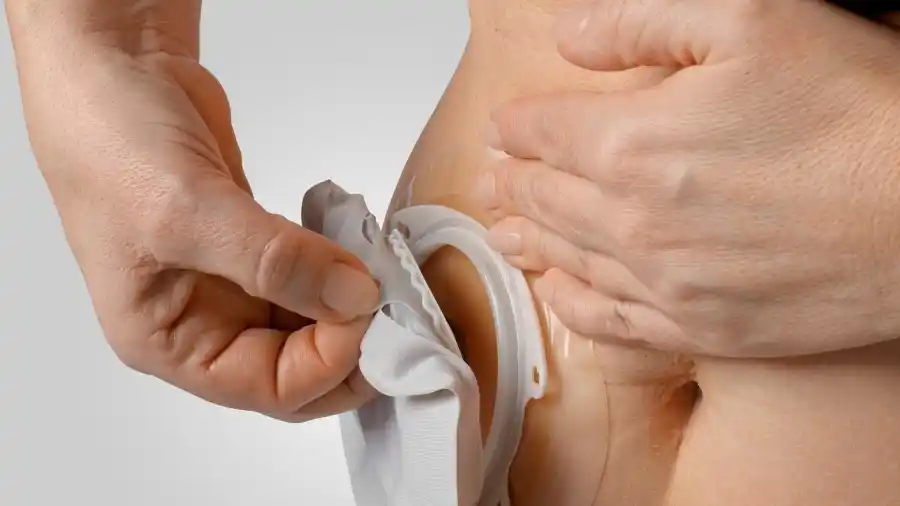 Once provincias adhirieron a la ley que incluye en el Plan Médico Obligatorio la cobertura de los dispositivos y elementos para las personas que tienen una ostomía.