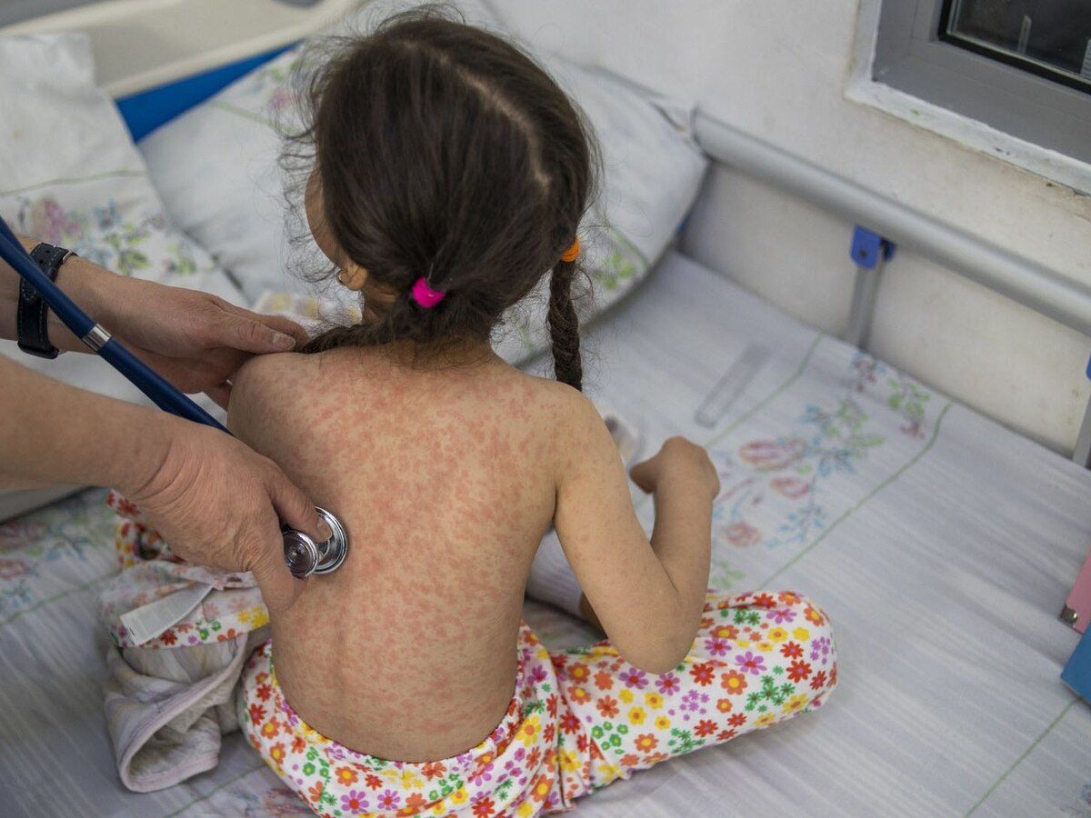 Alerta por sarampión: Quilmes lidera los contagios en el Conurbano y preocupa la baja vacunación infantil