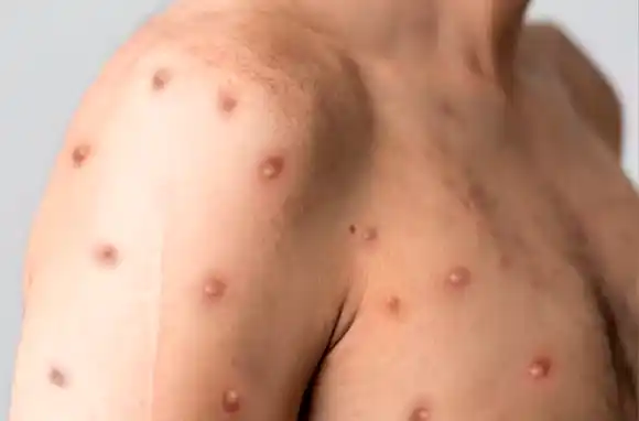 Viruela del mono: Salud aguarda el resultado de la muestra tomada al pasajero del buque en San Lorenzo