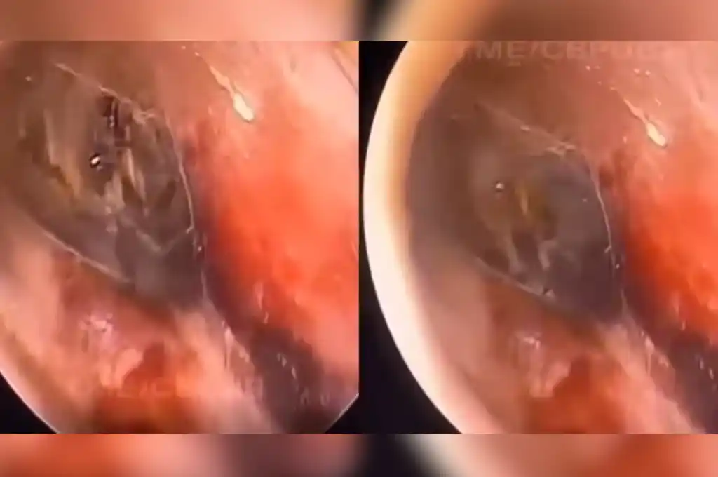 Sufría un fuerte dolor en el oído, fue al médico y descubrieron que tenía una araña: “Nunca más voy a poder dormir”