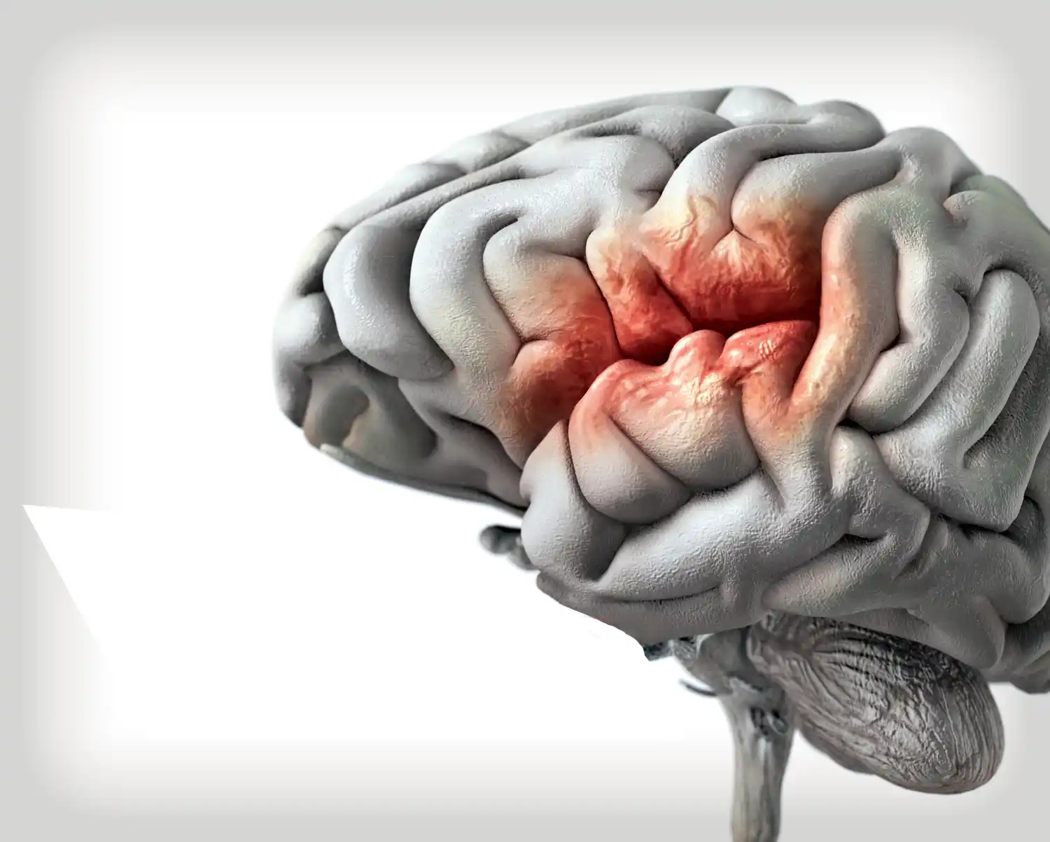 Ataque cerebral: Se produce uno cada 9 minutos