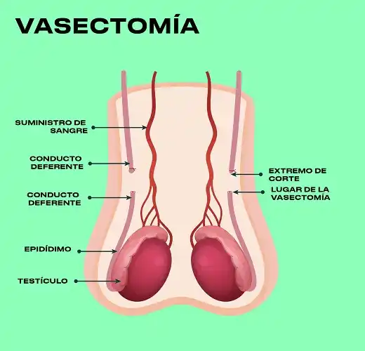 Vasectomía: “En la ciudad realizo entre 2 y 5 intervenciones por semana”
