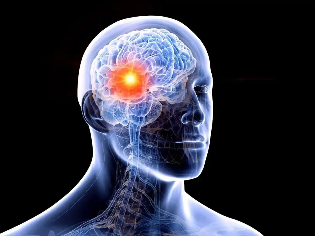 La epilepsia afecta a unas 300.000 personas en Argentina y su impacto va mucho más allá de las crisis convulsivas.