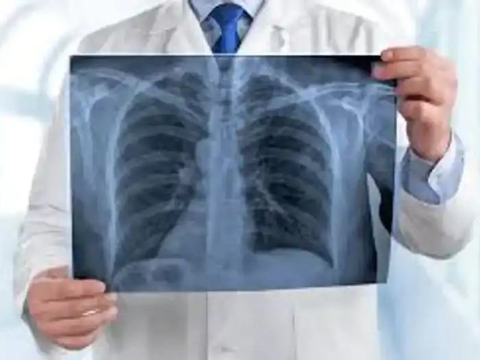 Día Mundial del Cáncer de Pulmón: advierten sobre el crecimiento sostenido de casos y la importancia del diagnóstico temprano